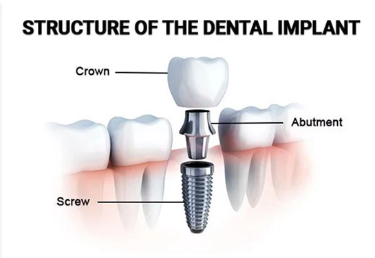 Dental implant structure diagram at Eagle Lake Family Dentistry